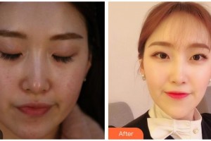 合肥壹加壹整形美容醫(yī)院王艷俠整形價(jià)格表附激光美膚激光案例展示