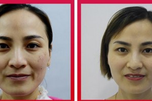 合肥壹加壹整形美容醫(yī)院金大生整形價(jià)格表附激光美膚激光案例展示