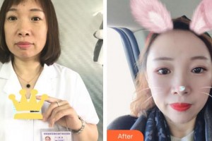 合肥壹加壹整形美容醫(yī)院周福田整形價格表附埋線提升案例展示