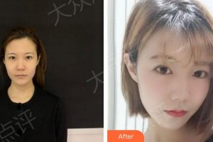 合肥壹加壹整形美容醫(yī)院余東整形價格表附熱瑪吉案例展示