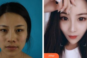 合肥藝星醫(yī)療美容醫(yī)院孫洋整形價(jià)格表附肋軟骨隆鼻案例展示