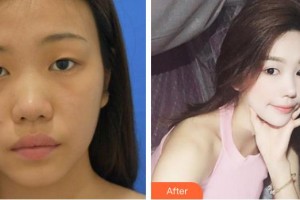 合肥凱美醫(yī)療美容醫(yī)院孫凱整形價(jià)格表附祛眼袋案例展示