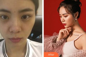 合肥崔勁松醫(yī)療美容診所石良兵整形價格表附雙眼皮修復(fù)案例展示