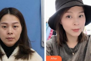 合肥童顏堂醫(yī)療美容醫(yī)院吳櫟佳整形價格表附眼部整形案例展示