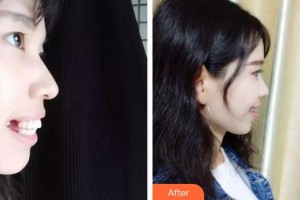 合肥童顏堂醫(yī)療美容醫(yī)院王璐瑜整形價格表附牙齒矯正案例展示
