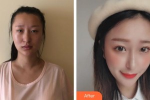 合肥童顏堂醫(yī)療美容醫(yī)院劉永飛整形價格表附埋線提升案例展示