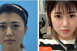 合肥童顏堂醫(yī)療美容醫(yī)院整形價格表附埋線提升案例展示