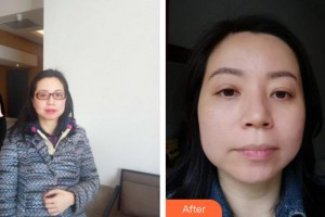 合肥童顏堂醫(yī)療美容醫(yī)院曾麗燕整形價格表附埋線提升案例展示