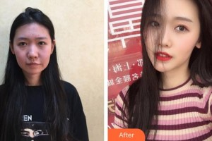 合肥光美醫(yī)療整形美容醫(yī)院張杰整形價(jià)格表附埋線提升案例展示