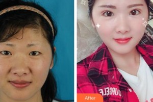 合肥臺(tái)美醫(yī)療美容門診部劉建龍整形價(jià)格表附切開雙眼皮案例展示