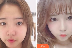 合肥翡睿醫(yī)療美容門診部楊森整形價格表附眼部綜合案例展示