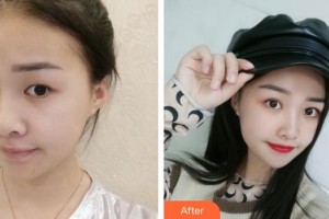 合肥美舒雅醫(yī)療美容診所李亞會整形價格表附切開雙眼皮案例展示