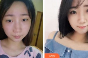 合肥玉顏醫(yī)療美容門診部翁曉娟整形價格表附切開雙眼皮案例展示