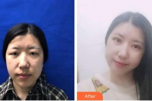 合肥名人眼科醫(yī)院陳林義整形價格表附眼部案例展示