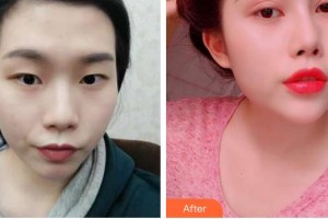 合肥名人眼科醫(yī)院劉君整形價格表附切開雙眼皮案例展示