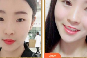 合肥愛爾眼科醫(yī)院李凱整形價格表附雙眼皮案例展示