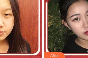 合肥愛爾眼科醫(yī)院王朝庭整形價格表附眼部綜合案例展示