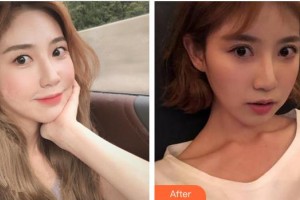 合肥愛爾眼科醫(yī)院胡盼整形價格表附切開雙眼皮案例展示