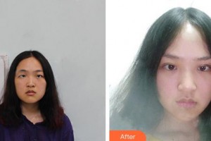 合肥愛爾眼科醫(yī)院殷西亮整形價格表附雙眼皮案例展示