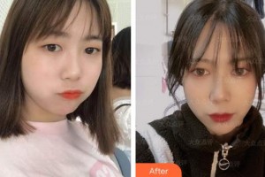 合肥愛爾眼科醫(yī)院李行整形價格表附激光去眼袋案例展示