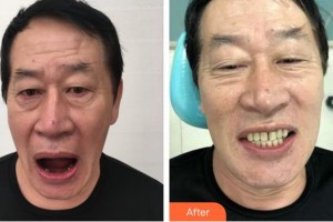 合肥瑞特曼口腔門診部魏敬謙整形價(jià)格表附種植牙案例展示