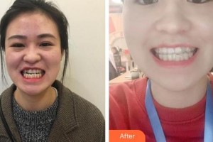 合肥瑞特曼口腔門診部黃志整形價(jià)格表附牙齒隱形矯正案例展示