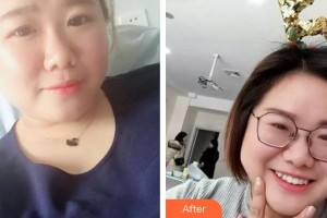 合肥貝杰口腔醫(yī)院焦宏春整形價(jià)格表附牙齒隱形矯正案例展示