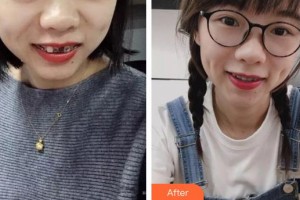 合肥貝杰口腔醫(yī)院周阿惠整形價(jià)格表附金屬托槽矯正案例展示