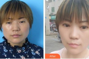 合肥東南眼科醫(yī)院葉玉華整形價(jià)格表附上瞼下垂、內(nèi)眼角案例展示