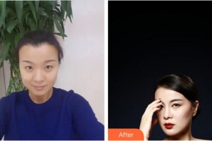 合肥東南眼科醫(yī)院張志明整形價格表附切開雙眼皮案例展示