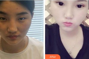 合肥東南眼科醫(yī)院汪澤整形價格表附切開雙眼皮案例展示