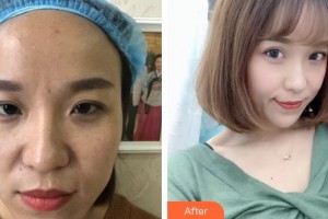 合肥東南眼科醫(yī)院杭煒整形價格表附眼部修復案例展示