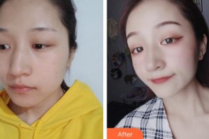 合肥東南眼科醫(yī)院夏博整形價格表附開內(nèi)眼角案例展示