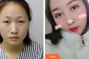 合肥東南眼科醫(yī)院楊建東整形價格表附眼部綜合案例展示