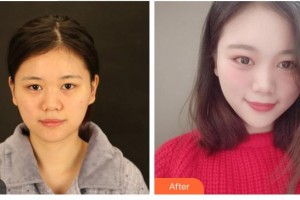 合肥普瑞眼科醫(yī)院朱鳳整形價格表附切開雙眼皮案例展示