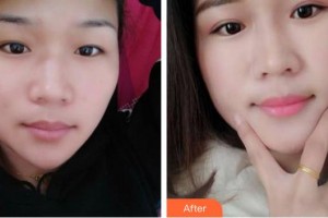 合肥普瑞眼科醫(yī)院馮晴整形價格表附埋線雙眼皮案例展示