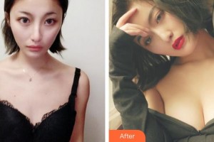 蕪湖蘭華醫(yī)療美容診所趙啟明整形價格表附假體隆胸案例展示