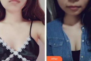 蕪湖華美醫(yī)療美容診所高翠華整形價格表附假體隆胸案例展示