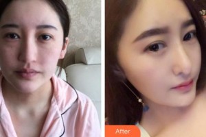 蕪湖伊萊美整形醫(yī)院何一波整形價格表附鼻部綜合案例展示