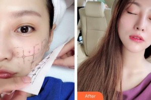 蕪湖伊萊美整形醫(yī)院賈利霞整形價格表附熱瑪吉案例展示