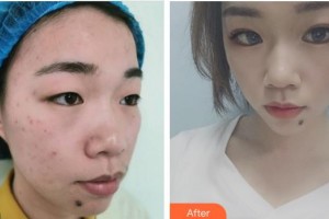 蕪湖伊萊美整形醫(yī)院田軍整形價格表附定點雙眼皮案例展示