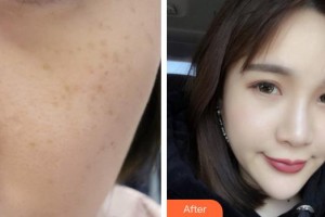 蕪湖瑞麗醫(yī)療美容門診部樊喜林整形價格表附超激光美膚案例展示