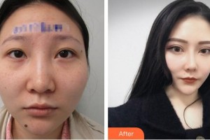 蕪湖瑞麗醫(yī)療美容門診部戴露倢整形價格表附眼部案例展示