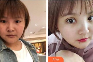 蕪湖瑞麗醫(yī)療美容門診部王俞明整形價格表附切開雙眼皮案例展示