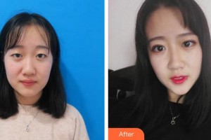 蕪湖壹加壹整形美容醫(yī)院王海龍整形價格表附定點雙眼皮案例展示