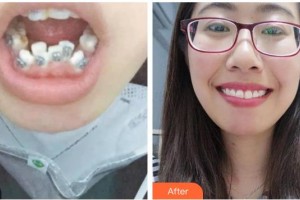 蕪湖壹加壹整形美容醫(yī)院蘭春祥整形價格表附金屬托槽矯正案例展示