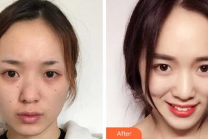 蕪湖壹加壹整形美容醫(yī)院時偉整形價格表附鼻部綜合案例展示