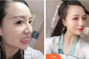 蕪湖壹加壹整形美容醫(yī)院馬小兵整形價格表附牙齒隱形矯正案例展示