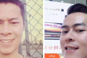 蕪湖美人魚醫(yī)療美容醫(yī)院王俊整形價格表附金屬托槽矯正案例展示