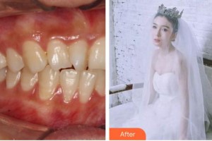 蕪湖一秒醫(yī)療美容醫(yī)院邵榮整形價格表附牙齒隱形矯正案例展示